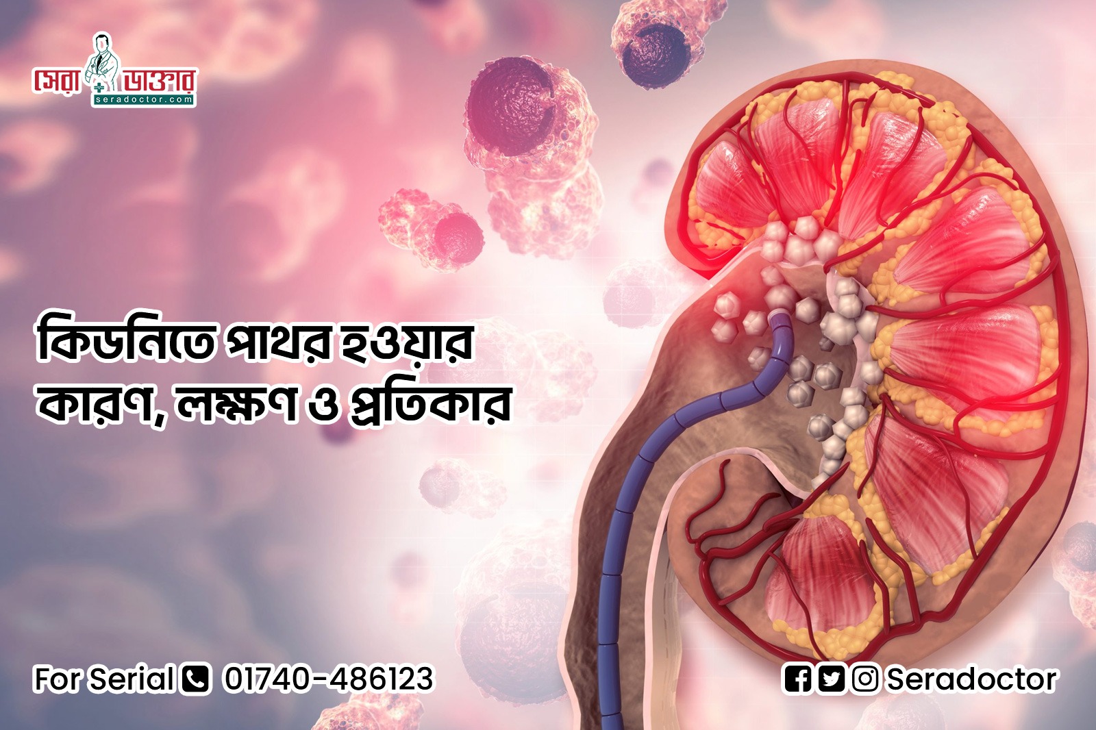 কিডনিতে পাথর হওয়ার কারণ, লক্ষণ ও প্রতিকার, Kidney Stone